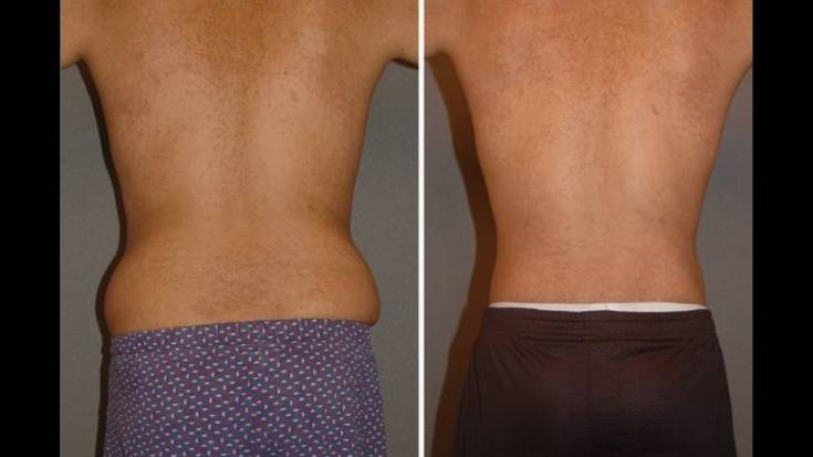 What should I wear to smooth back fat? Bra-Back-Fat-376